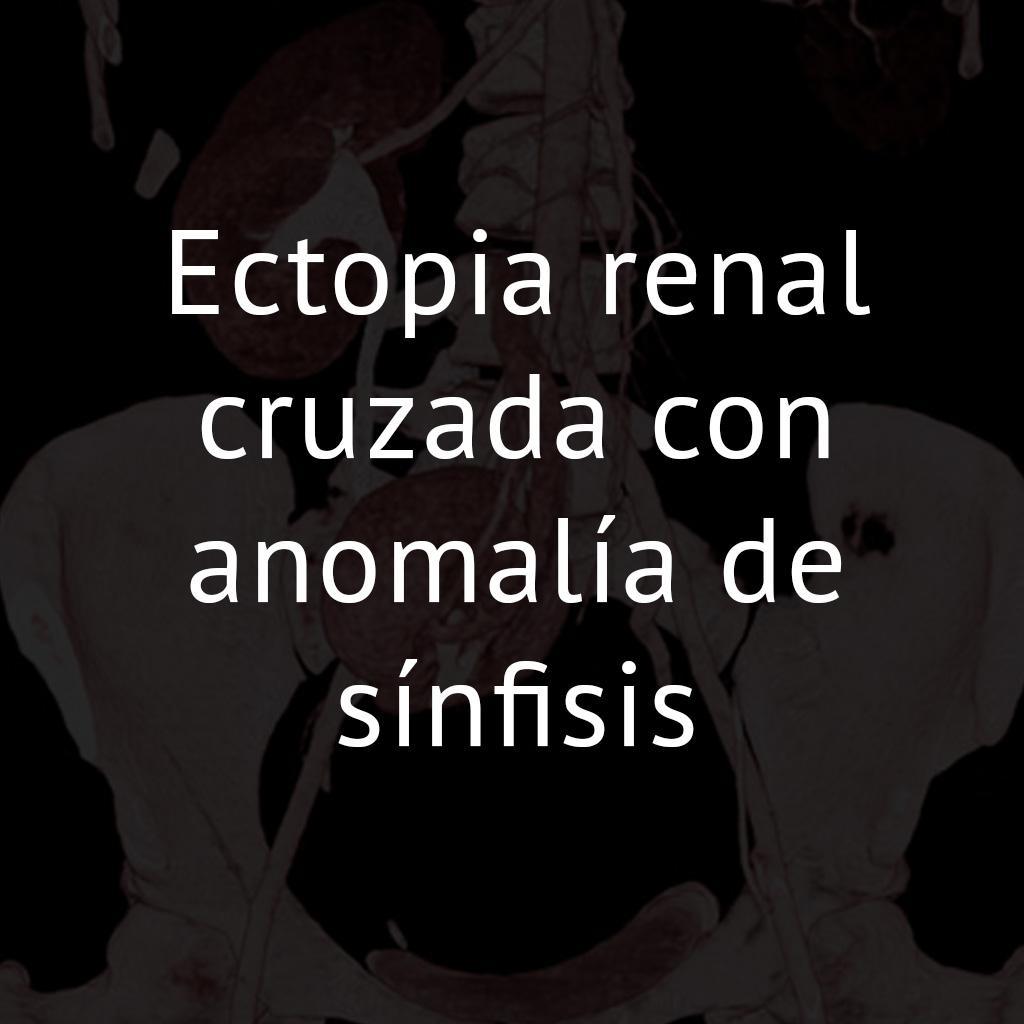 Ectopia renal cruzada con anomalía de sínfisis