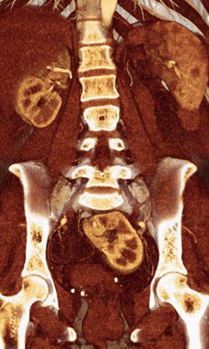 Ectopia renal pélvica