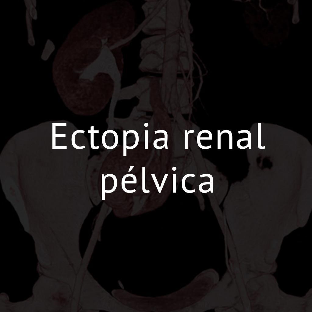 Ectopia renal pélvica