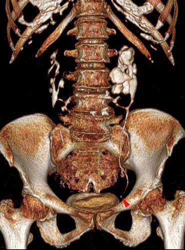 Riñón en herradura. Obstrucción por litiasis ureteral