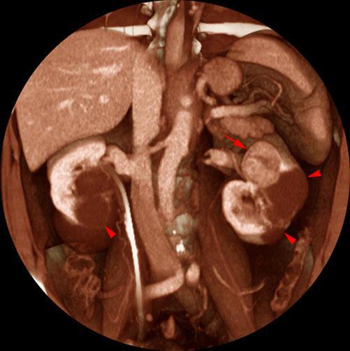 Quiste renal multitabicado e hipernefroma