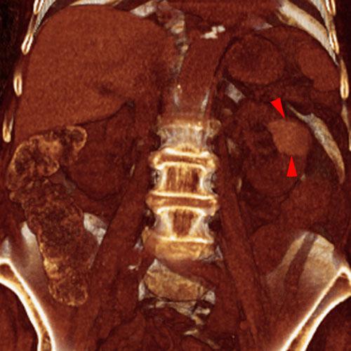Quiste renal hemorrágico