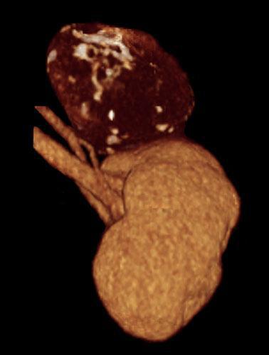 Quiste renal calcificado