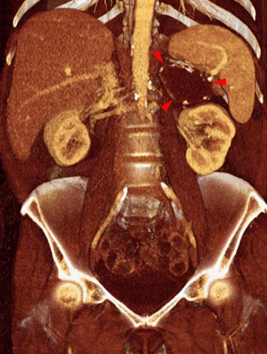 Quiste renal calcificado