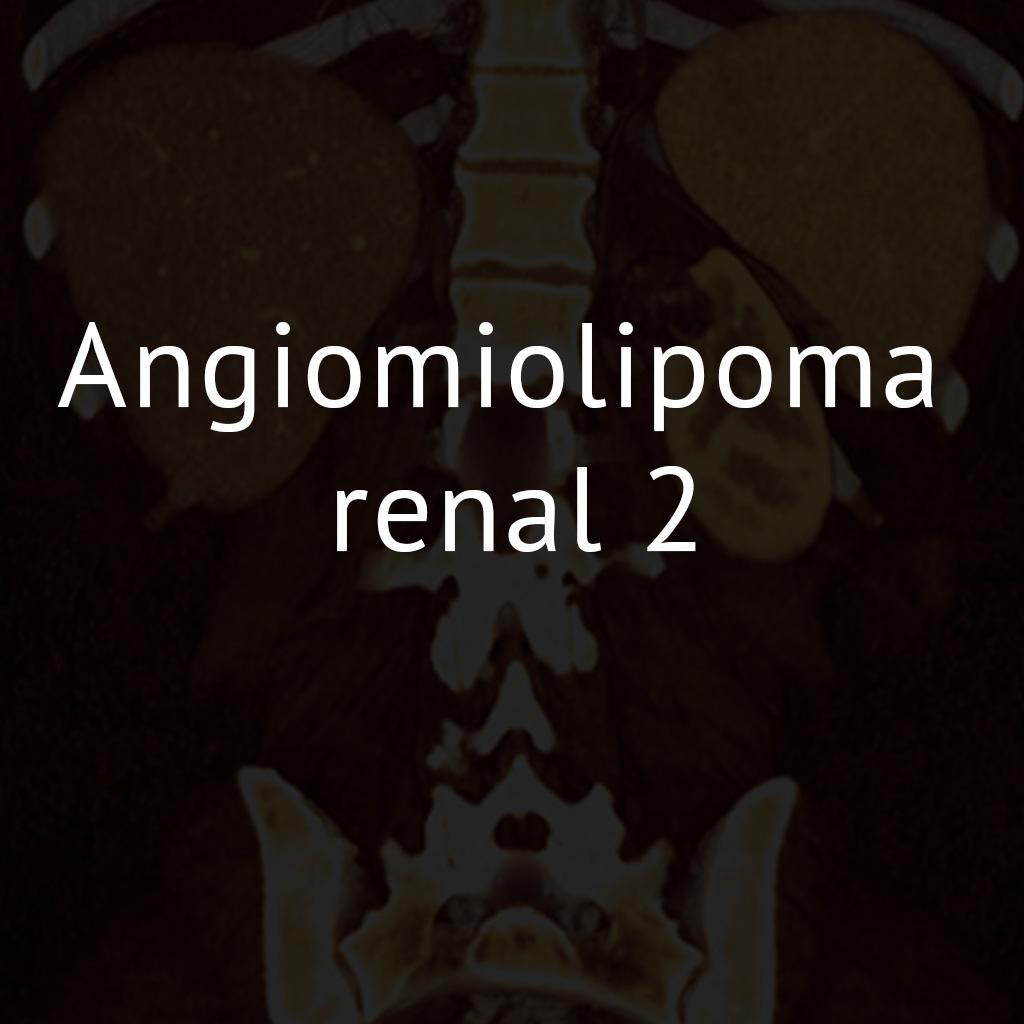 Angiomiolipoma renal 2