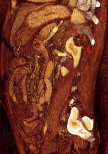 Angiomiolipoma renal 1