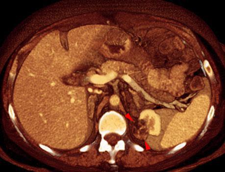 Angiomiolipoma renal 1
