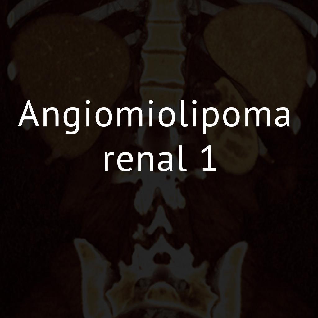 Angiomiolipoma renal 1