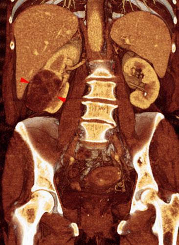 Nefroma quístico multilocular