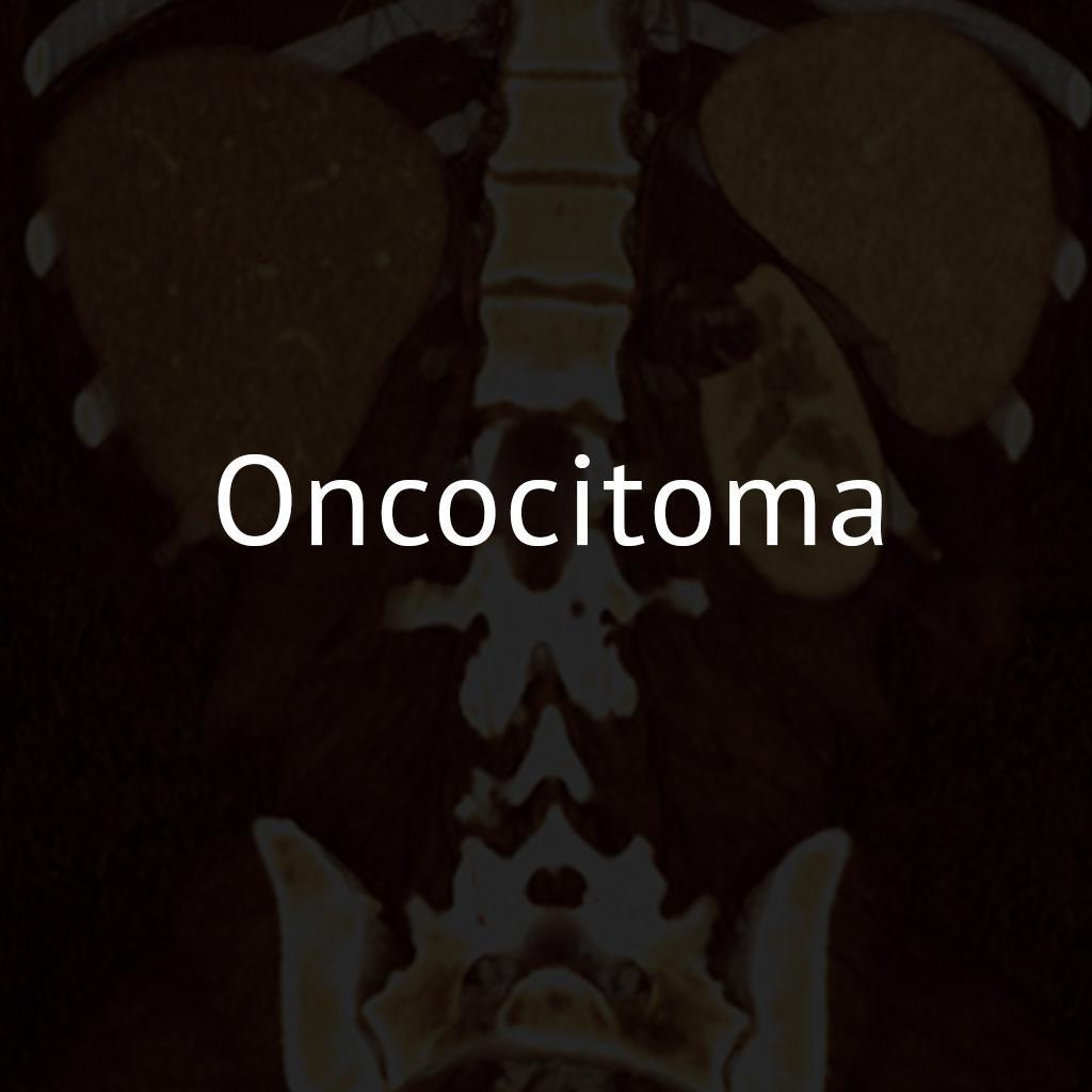 Oncocitoma