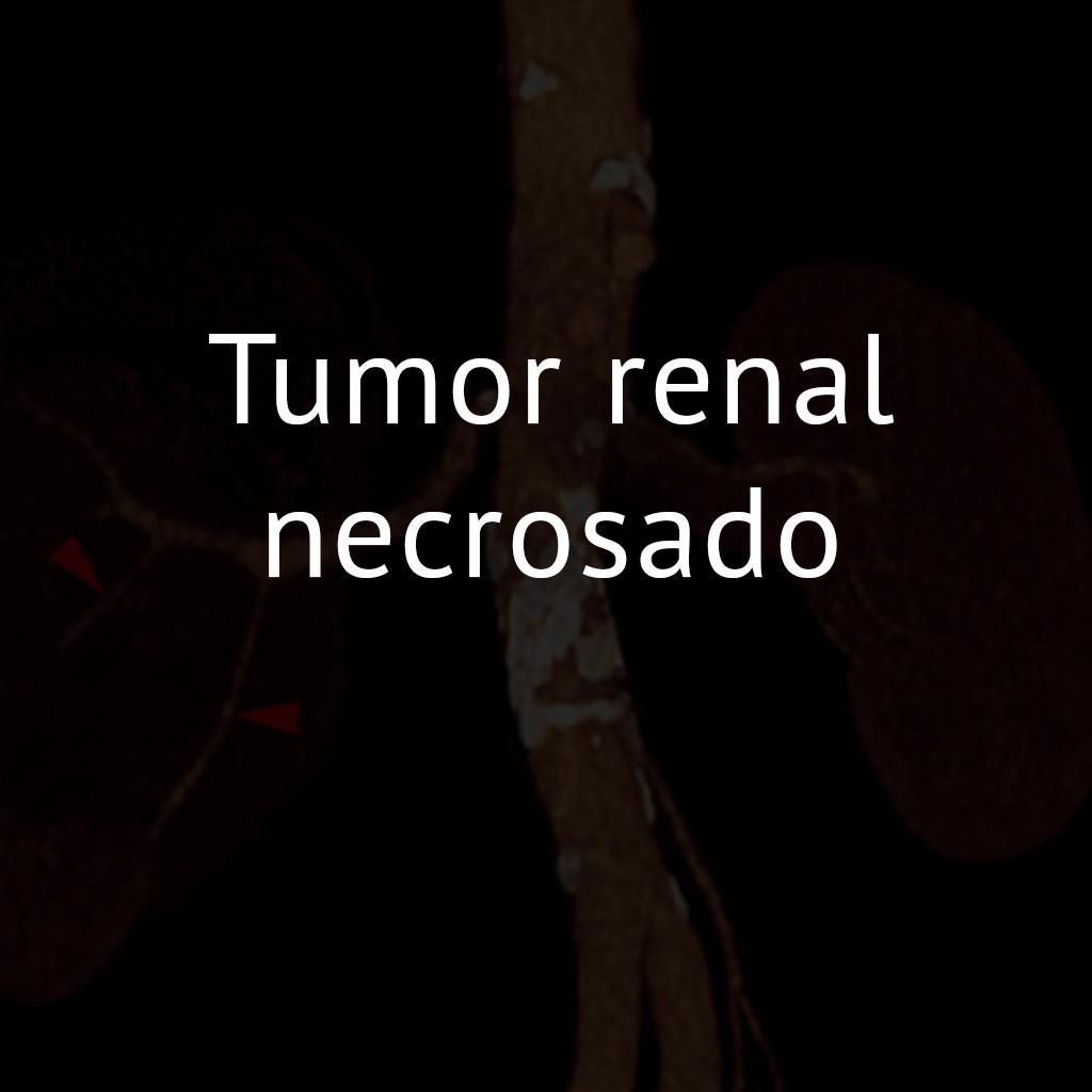 Tumor renal necrosado