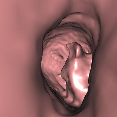 Tumor renal. Invasión de vía urinaria