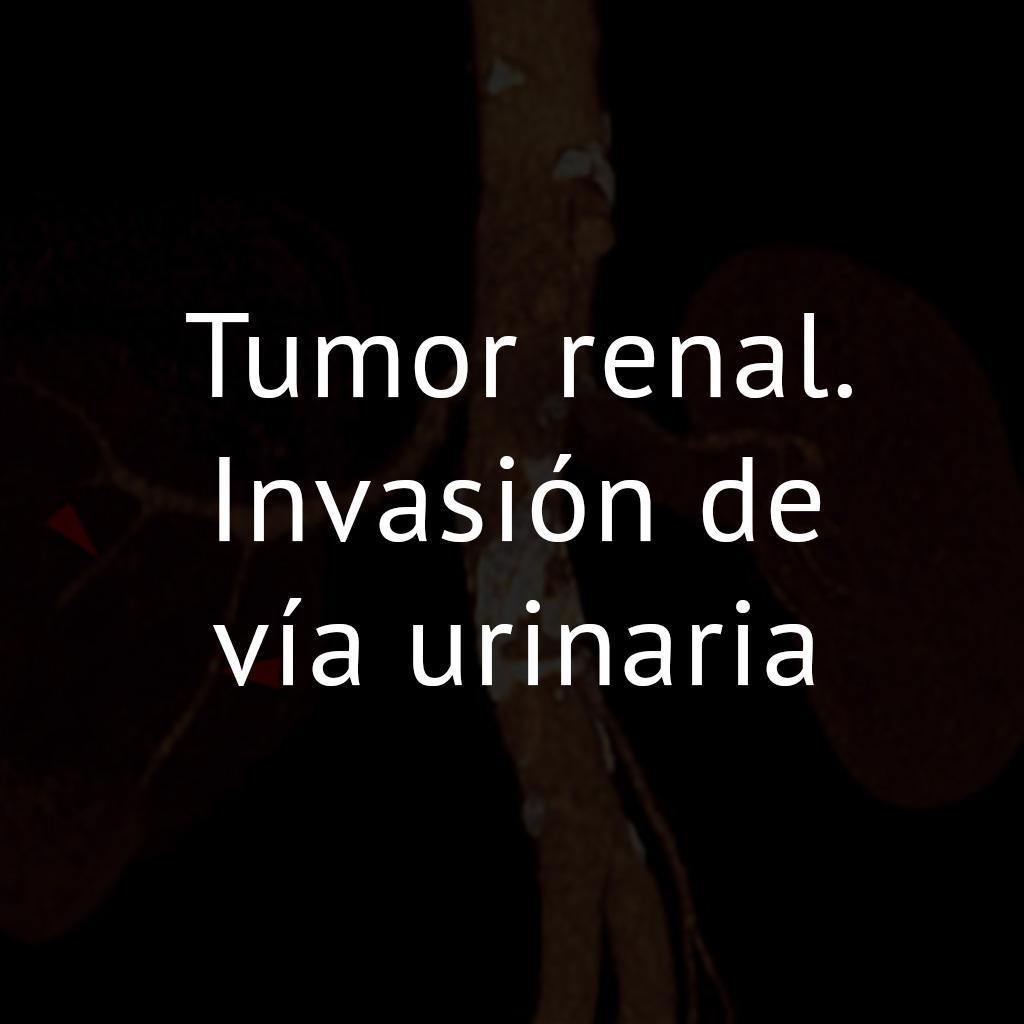 Tumor renal. Invasión de vía urinaria