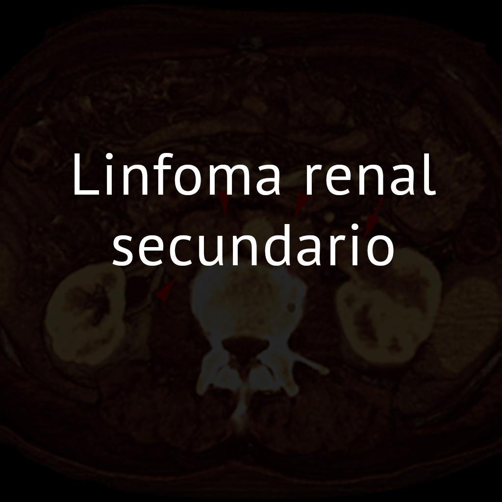 Linfoma renal secundario