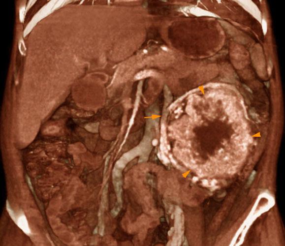 Hipernefroma muy vascularizado