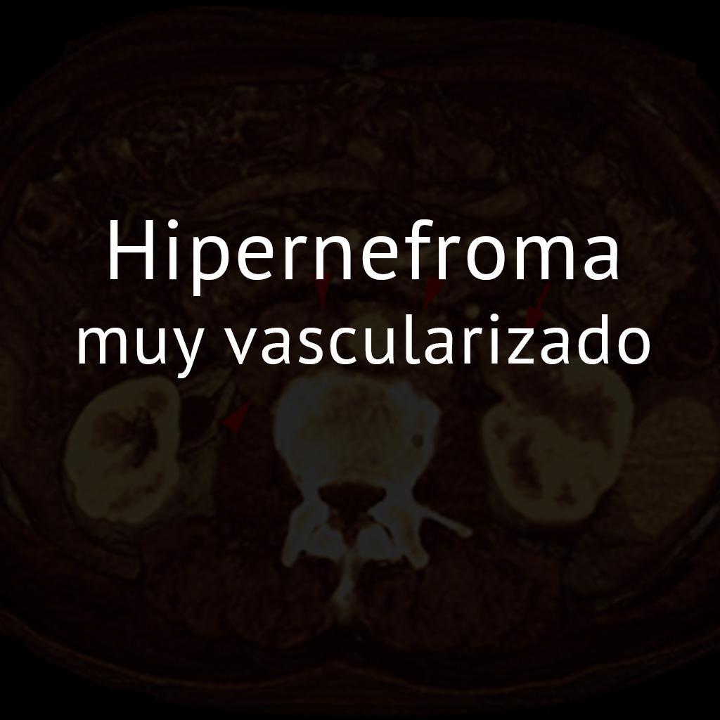 Hipernefroma muy vascularizado