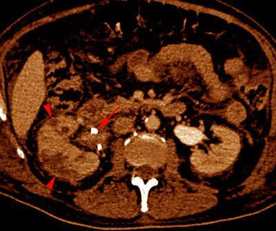 Abscesos renales en pionefrosis