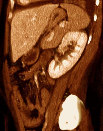 Pielonefritis aguda 1