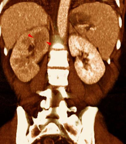 Pielonefritis aguda 1