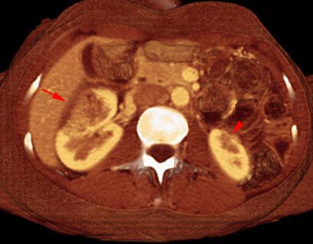 Pielonefritis bilateral aguda y crónica