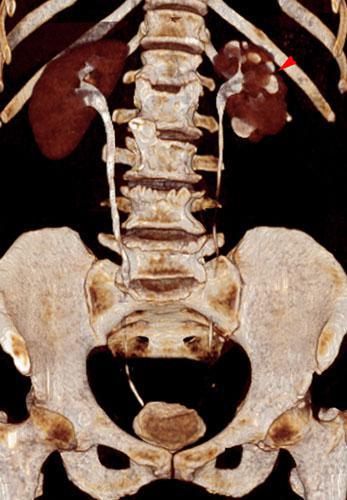 Pielonefritis crónica en tbc