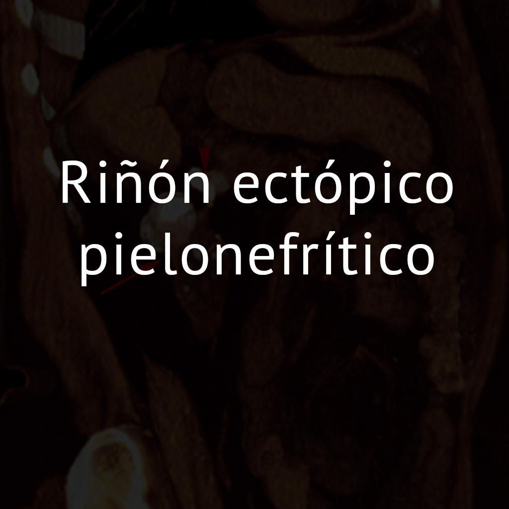 Riñón ectópico pielonefrítico