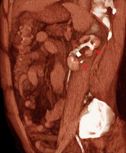 Pielonefritis crónica