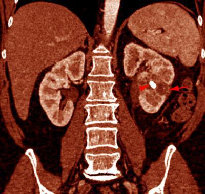 Pielonefritis xantogranulomatosa