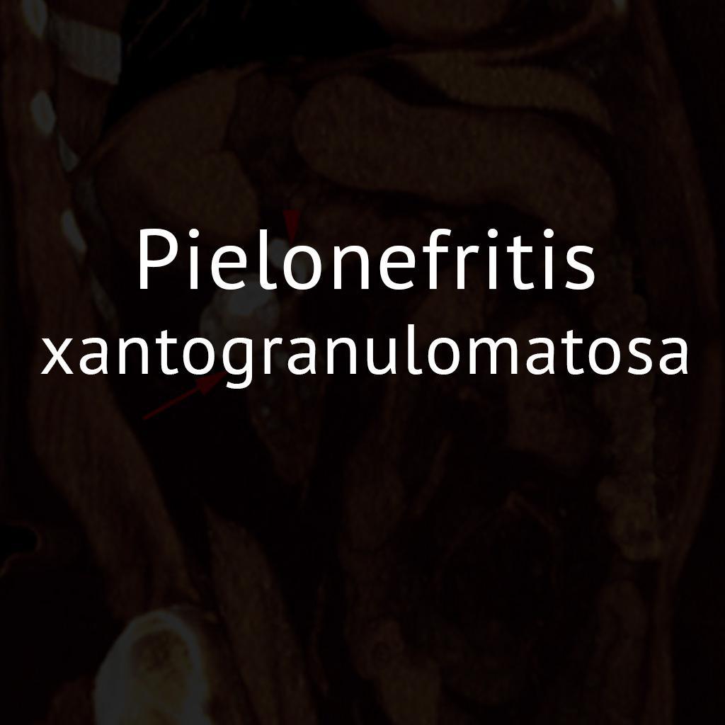 Pielonefritis xantogranulomatosa
