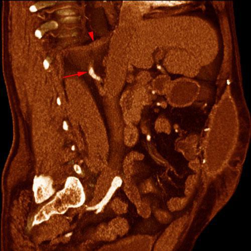 Arteria renal torácica