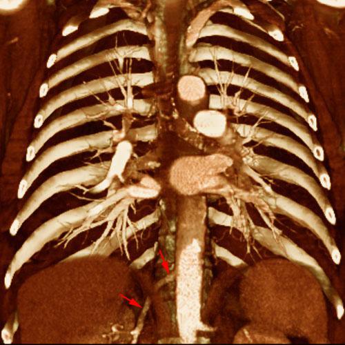 Arteria renal torácica