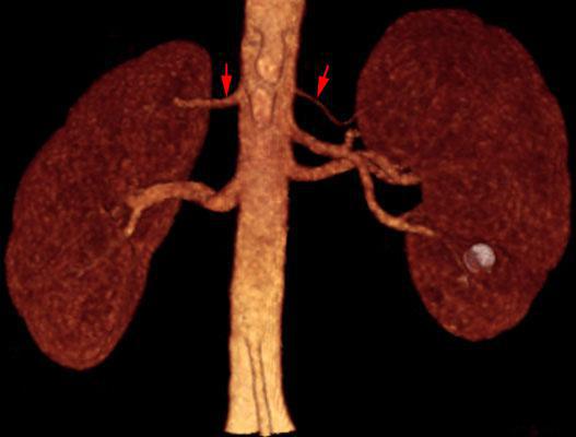 Arterias renales polares