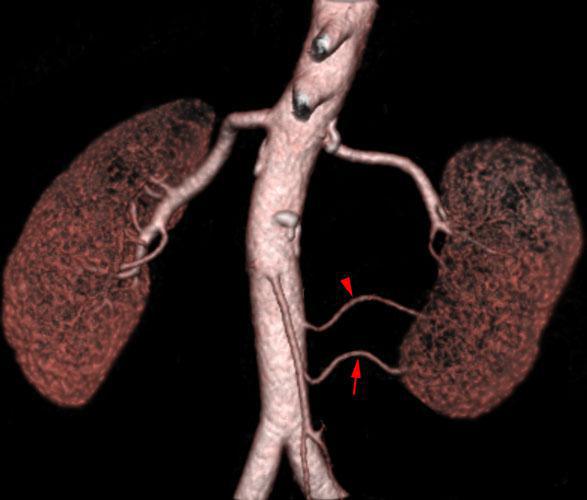 Arterias renales polares