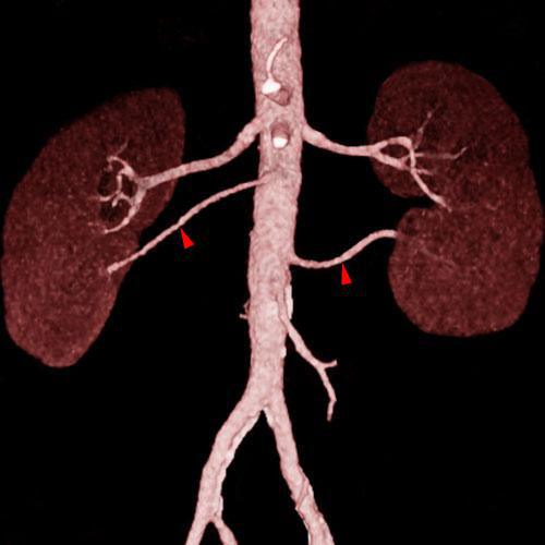 Arterias renales accesorias