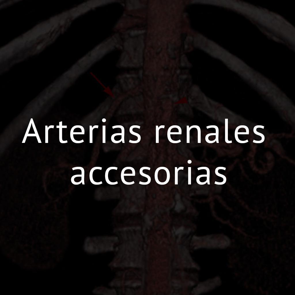 Arterias renales accesorias