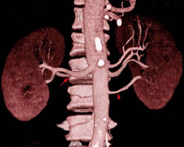 Arterias renales múltiples