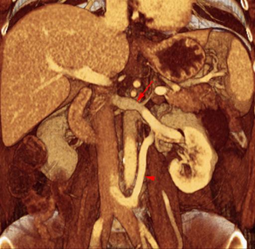 Vena renal izquierda circumaórtica baja