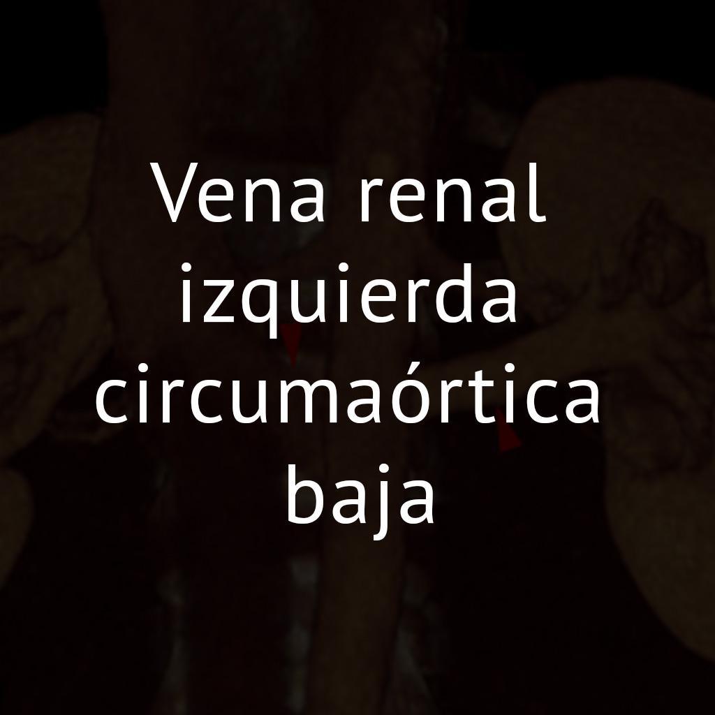 Vena renal izquierda circumaórtica baja