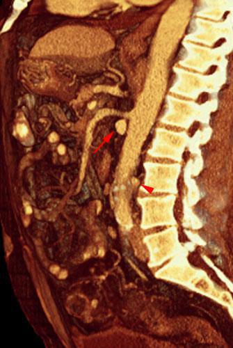 Vena renal izquierda circumaórtica