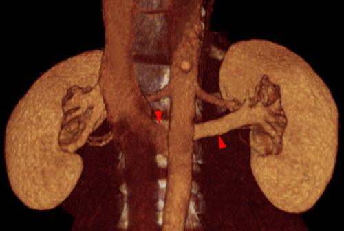 Vena renal izquierda retroaórtica