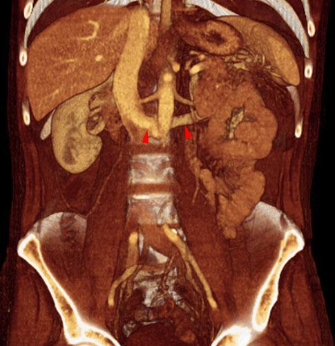 Vena renal izquierda retroaórtica