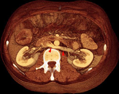 Vena renal izquierda retroaórtica