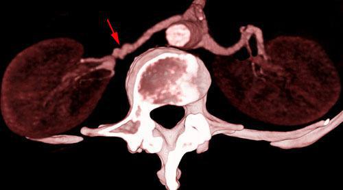 Estenosis por displasia fibromuscular de arterias renales