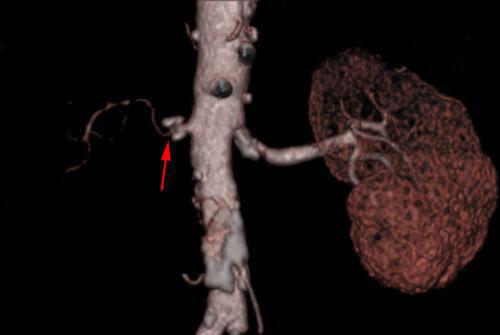 Estenosis intensa de arteria renal 2