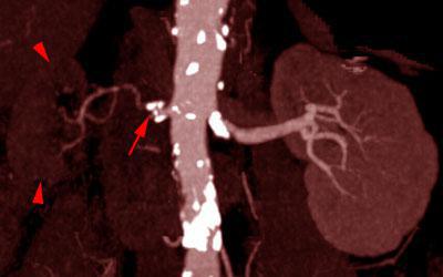 Estenosis intensa de arteria renal 2