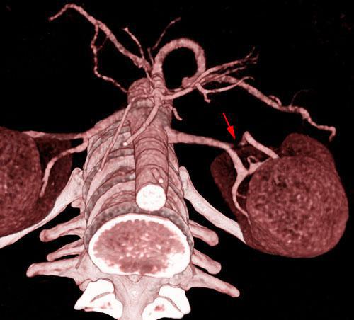 Estenosis moderada de arteria renal