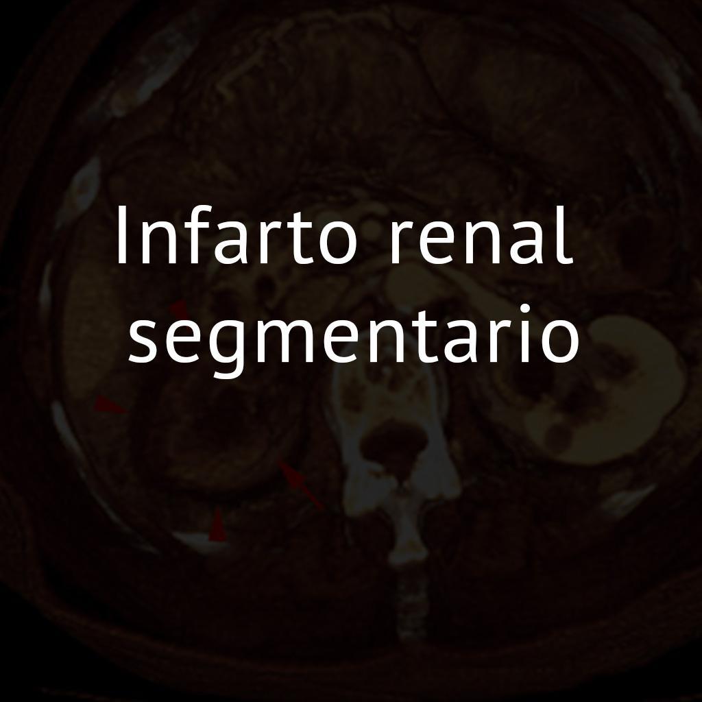Infarto renal segmentario