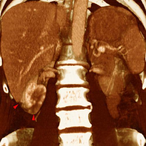 Infartos renales múltiples