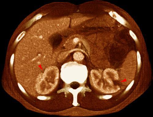 Infartos renales múltiples