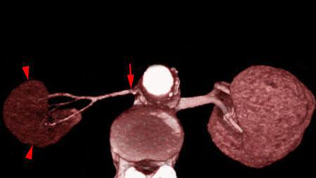 Isquemia renal crónica